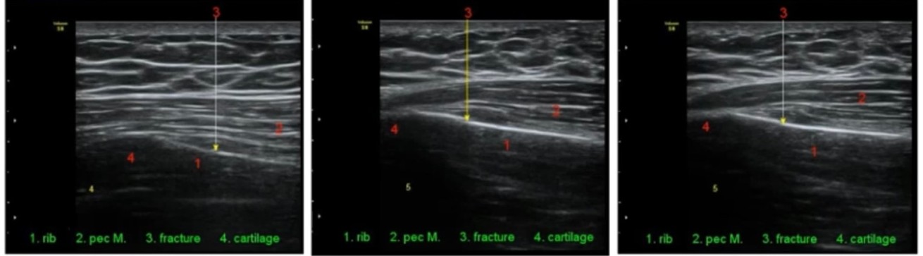 늑골골절 한방치료 — 초음파로 확인한 늑골(갈비뼈) 골절, rib·fracture 표시 영상
